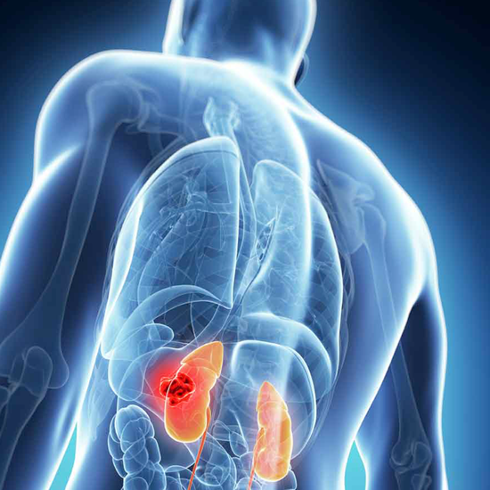 ENFERMEDAD RENAL CRÓNICA 1